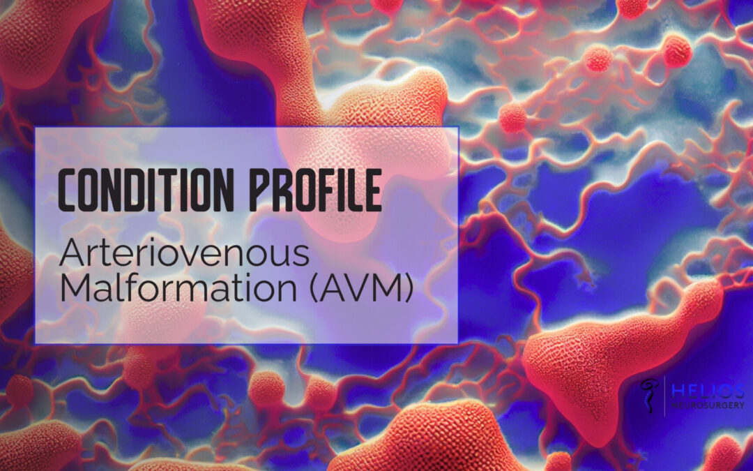 Arteriovenous Malformation (AVM)