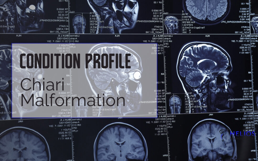 Chiari Malformation