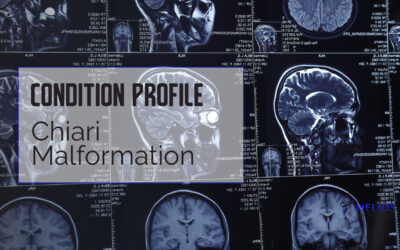 Chiari Malformation