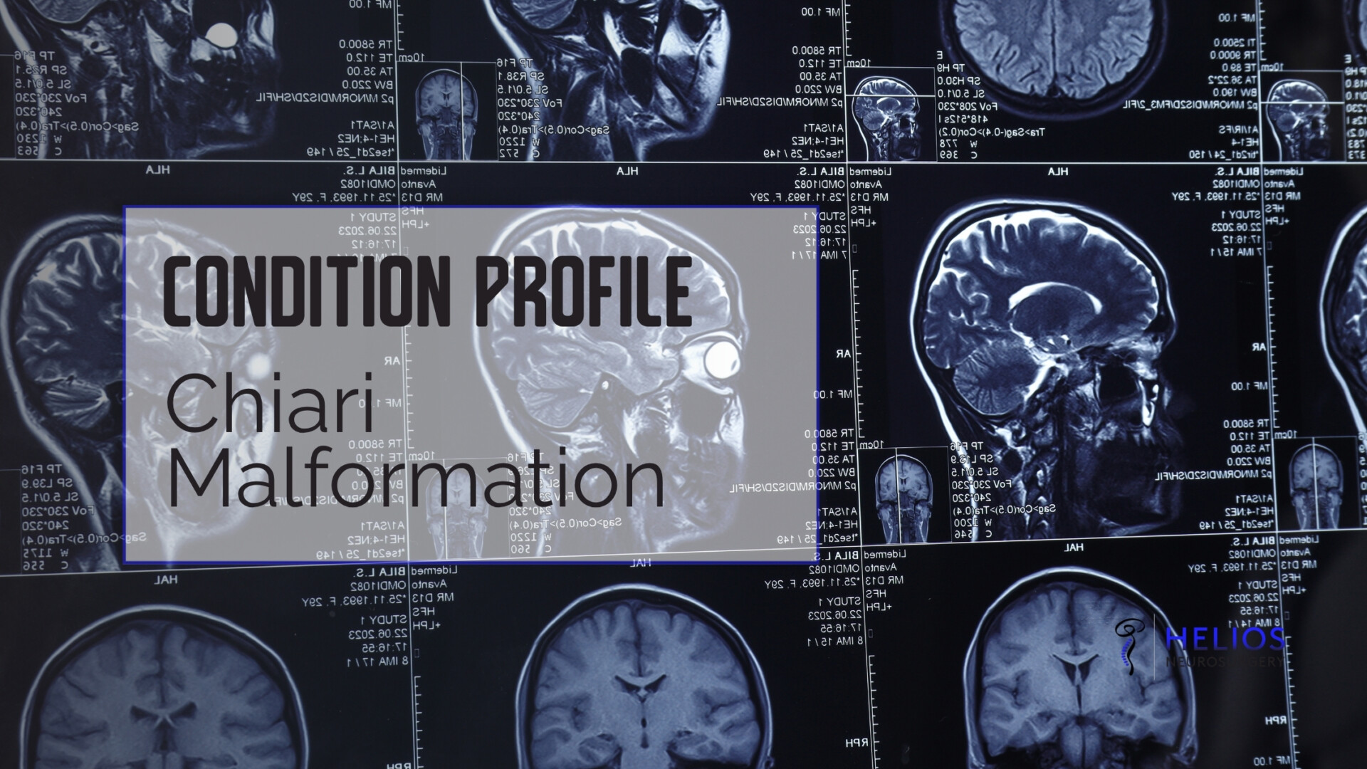 HLN Chiari Malformation