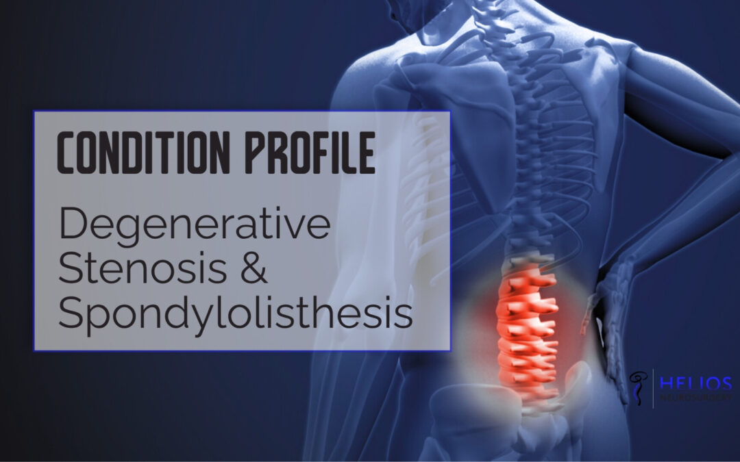 Degenerative Stenosis & Spondylolisthesis
