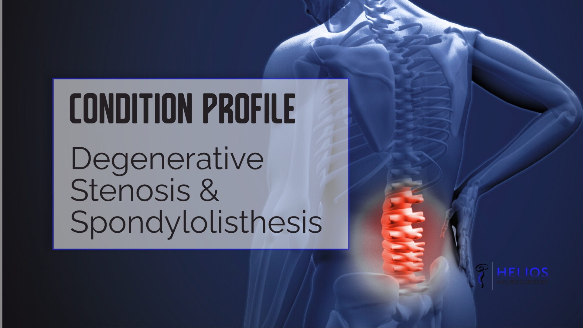 HLN Degenerative Stenosis & Spondylolisthesis