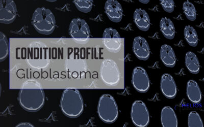 Glioblastoma (GBM)