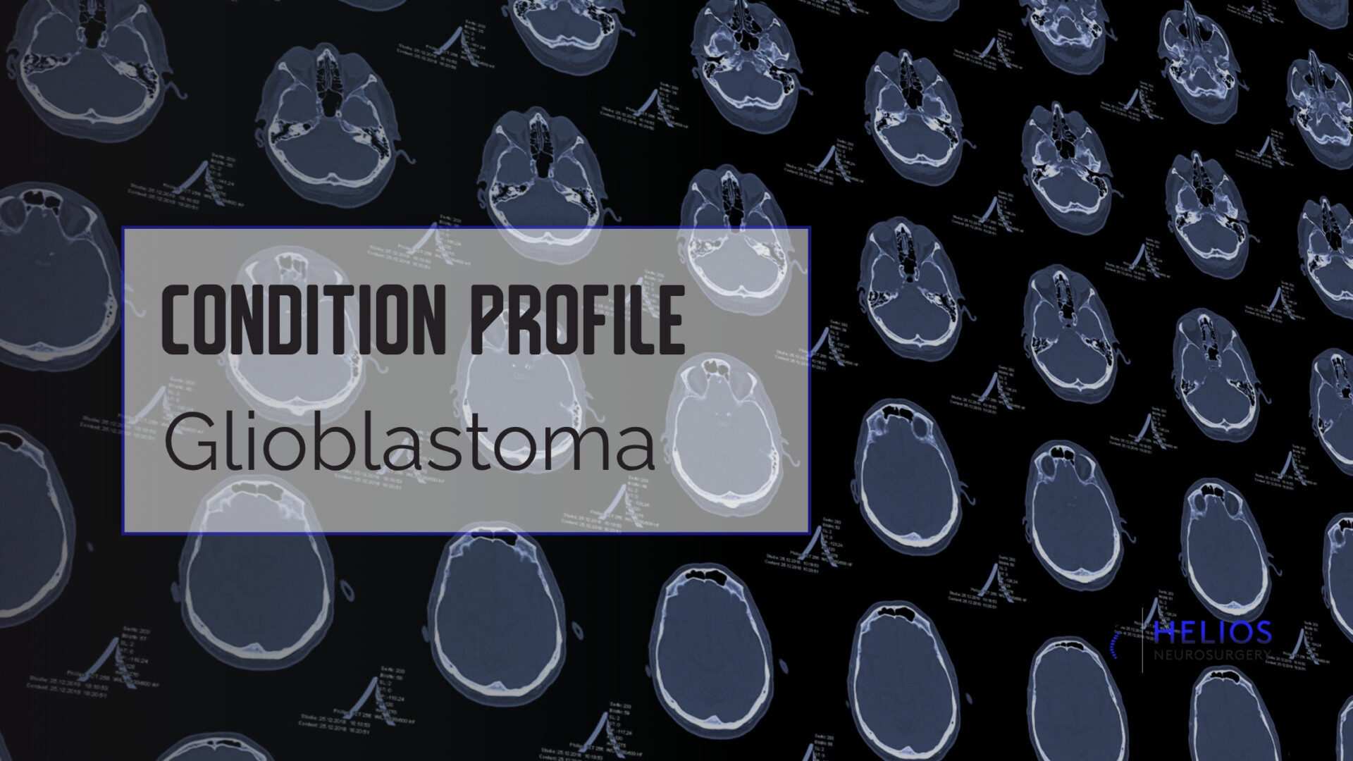 HLN Glioblastoma