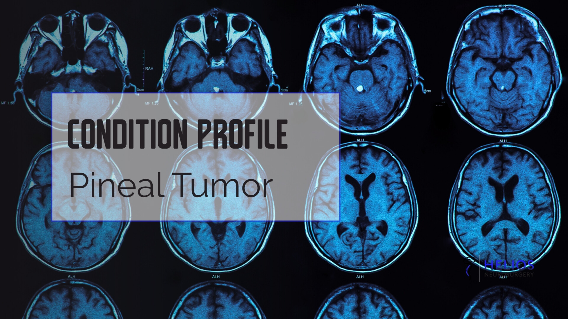 HLN Pineal Tumor