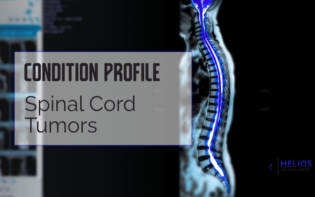 Spinal Cord Tumors