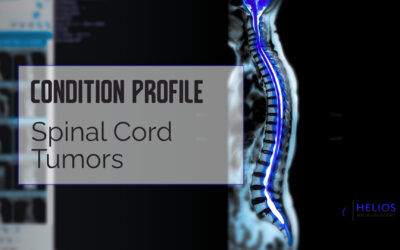 Spinal Cord Tumors