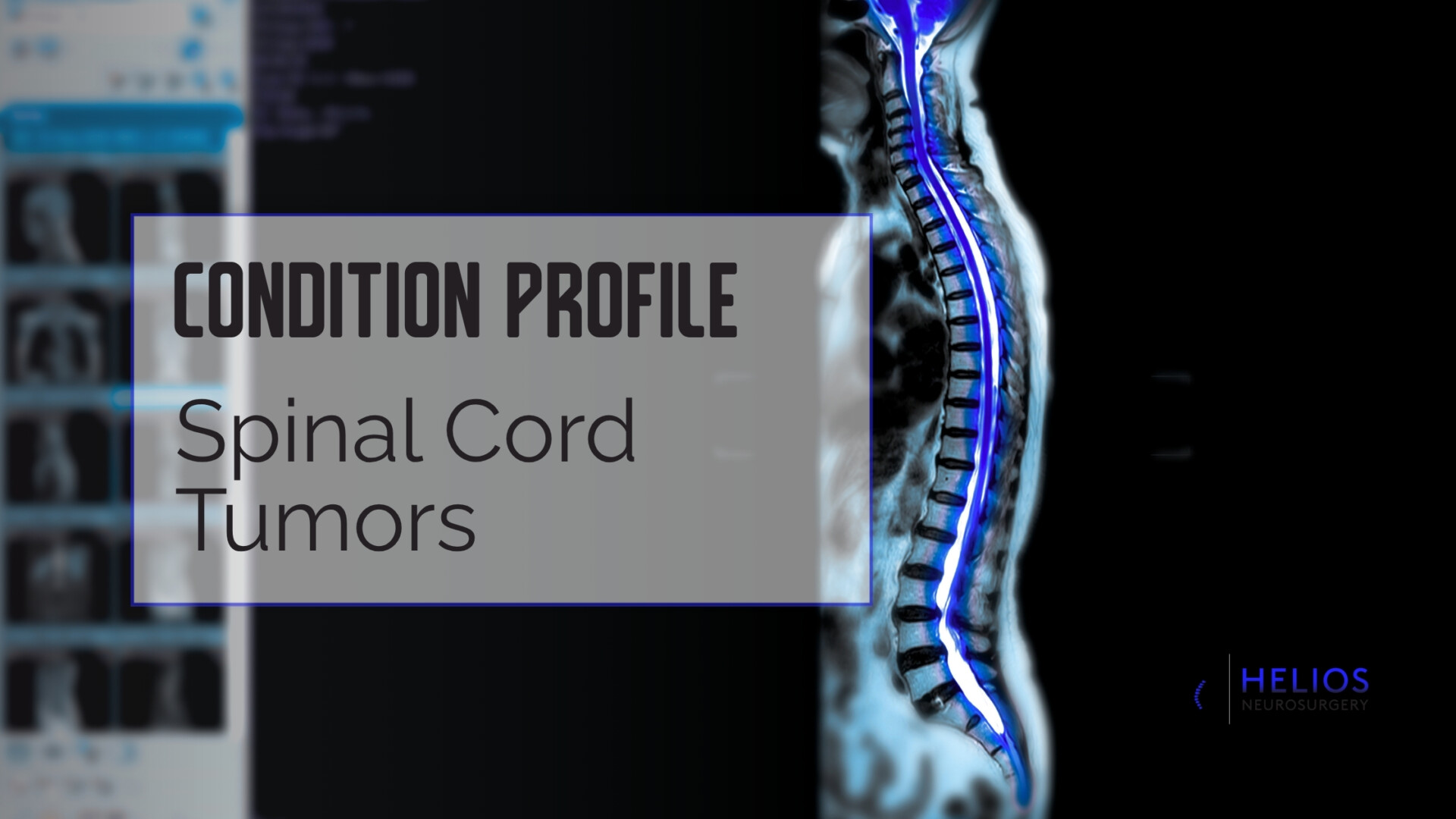 HLN Spinal Cord Tumors