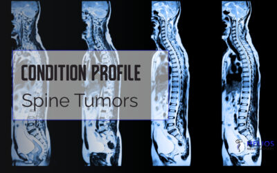 Spine Tumors