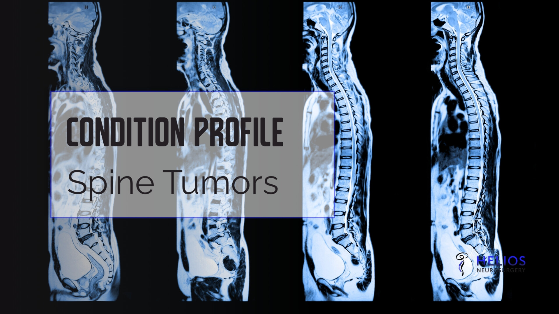 HLN Spine Tumors